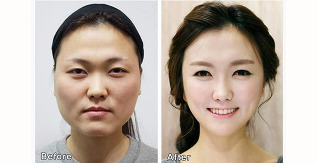 Due volti di ragazza, prima e dopo la chirurgia estetica - Corea